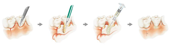 エムドゲイン（歯周組織再生療法）のイラスト