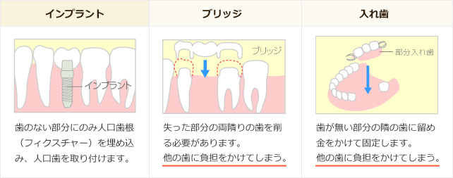 インプラント、ブリッジ、入れ歯の比較イラスト